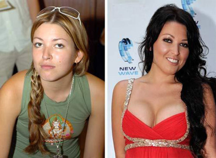 Ирина Дубцова до и после пластики груди