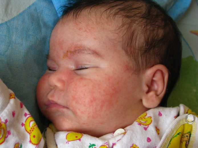 Пример аллергического высыпания у малыша на лице