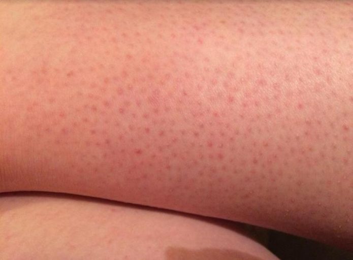 красные точки на коже ног после бритья