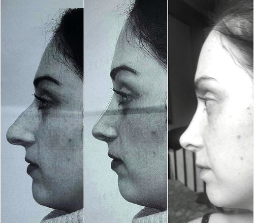 Три изображения одной и той же женщины с разной формой носа