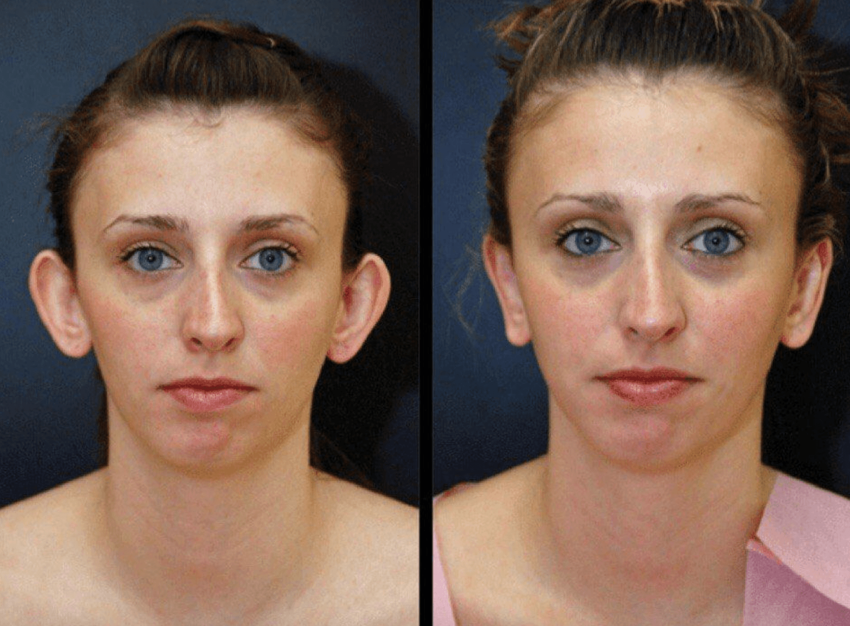 отопластика фото до и после операции