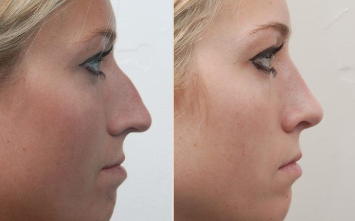 Фото женщины до и после ринопластики