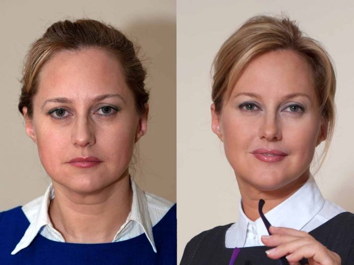 Фото женщины до и после введения имплантатов