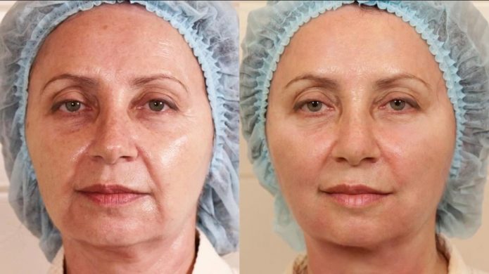 Фото пациентки до и после армирования жидкими нитями