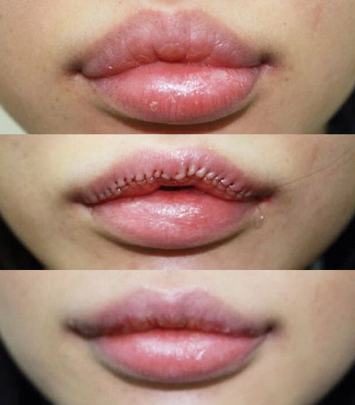 Фото губ до, во время операции по уменьшению и после нее