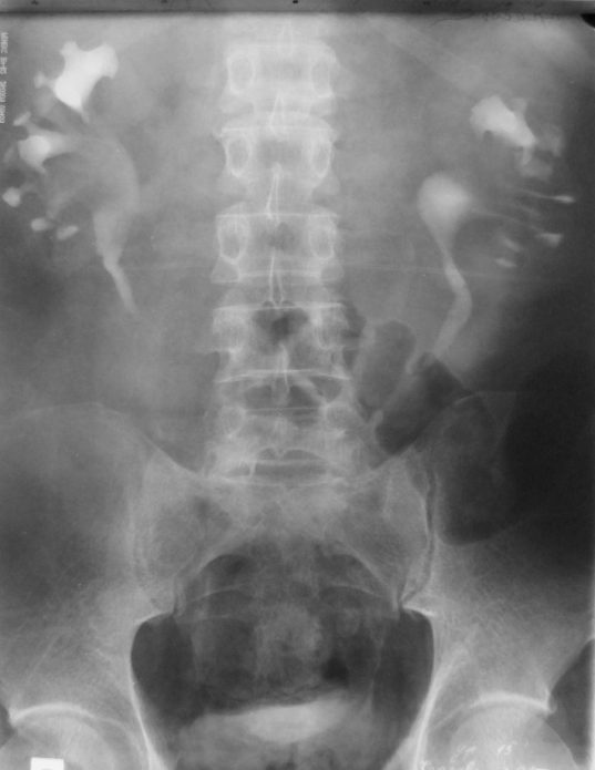 Рентгеновский снимок почек