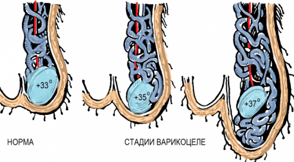 Стадии развития варикоцеле